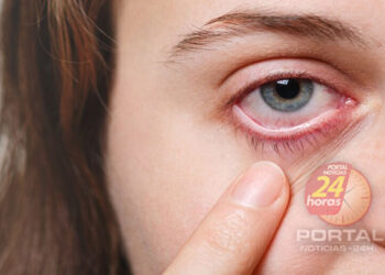 Oftalmologista explica que dengue também pode afetar os olhos