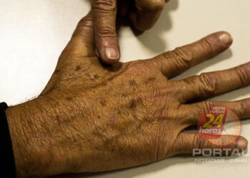 [Câncer de pele] Com a chegada do verão, prevenção é fundamental para evitar a doença